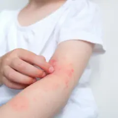 Dziecko drapie swędzącą rękę z zaczerwienioną wysypką alergiczną.