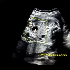 USG płodu z widocznymi dwoma naczyniami w pęcherzu. W ciąży z wielowodziem, obraz pokazuje kluczowe elementy do dalszej diagnostyki.
