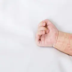 Rączka dziecka z drobną, czerwoną wysypką przypominającą kaszkę mannę.