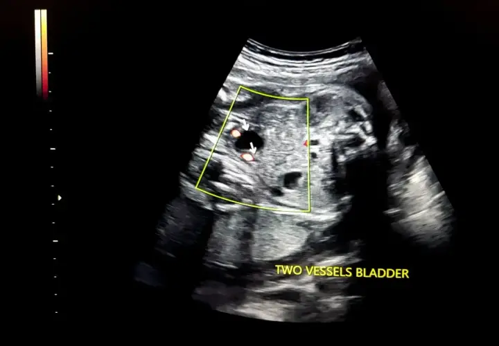 USG płodu z widocznymi dwoma naczyniami w pęcherzu. W ciąży z wielowodziem, obraz pokazuje kluczowe elementy do dalszej diagnostyki.