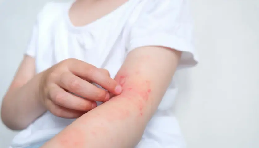 Dziecko drapie swędzącą rękę z zaczerwienioną wysypką alergiczną.