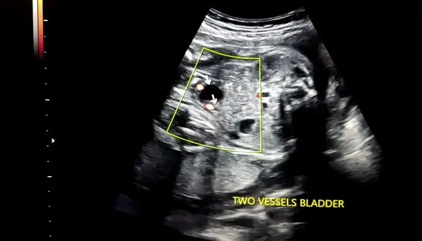 USG płodu z widocznymi dwoma naczyniami w pęcherzu. W ciąży z wielowodziem, obraz pokazuje kluczowe elementy do dalszej diagnostyki.