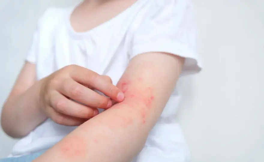 Wysypka alergiczna u dziecka - jak ją rozpoznać i kiedy reagować