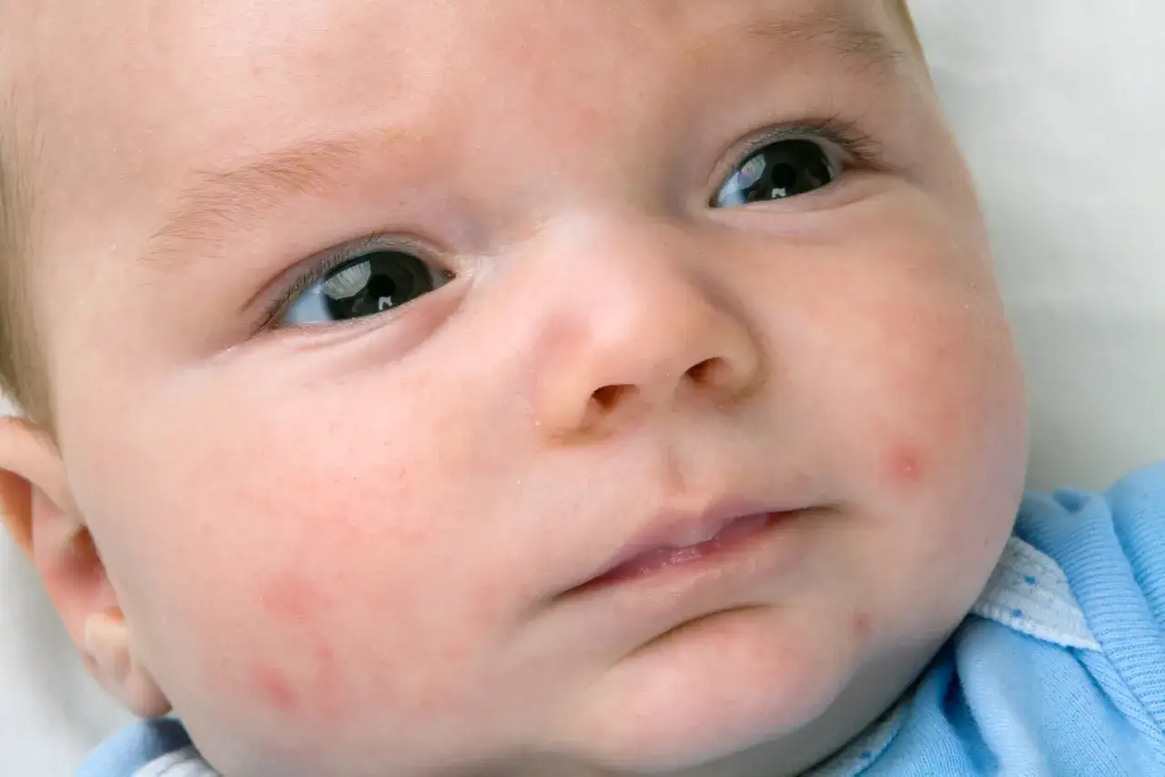 Skóra niemowlaka z zaczerwienieniami i krostkami, możliwe objawy alergii.