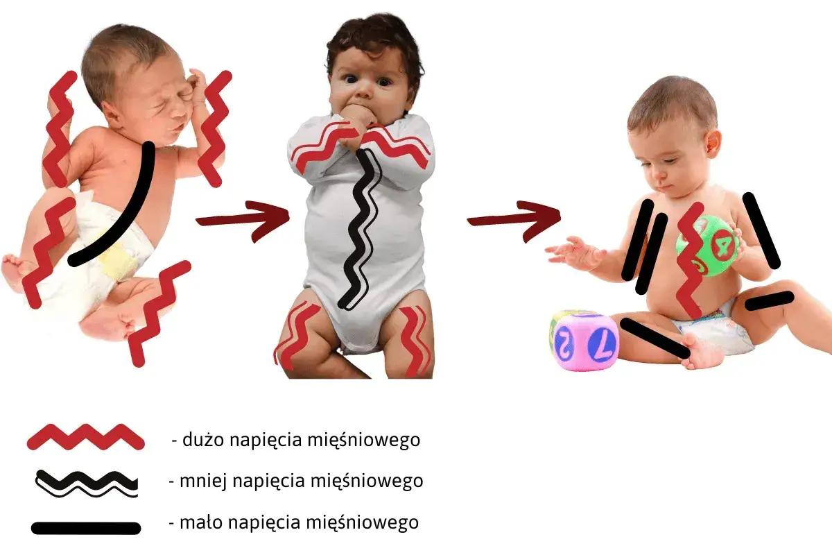U niemowlaka objawy wzmożone napięcie mięśniowe a sen: od nadmiernego napięcia do rozluźnienia.
