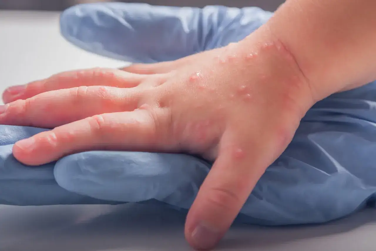 Dziecięca dłoń z licznymi, czerwonymi bąbelkami &ndash; to wyraźna wysypka alergiczna u dziecka.